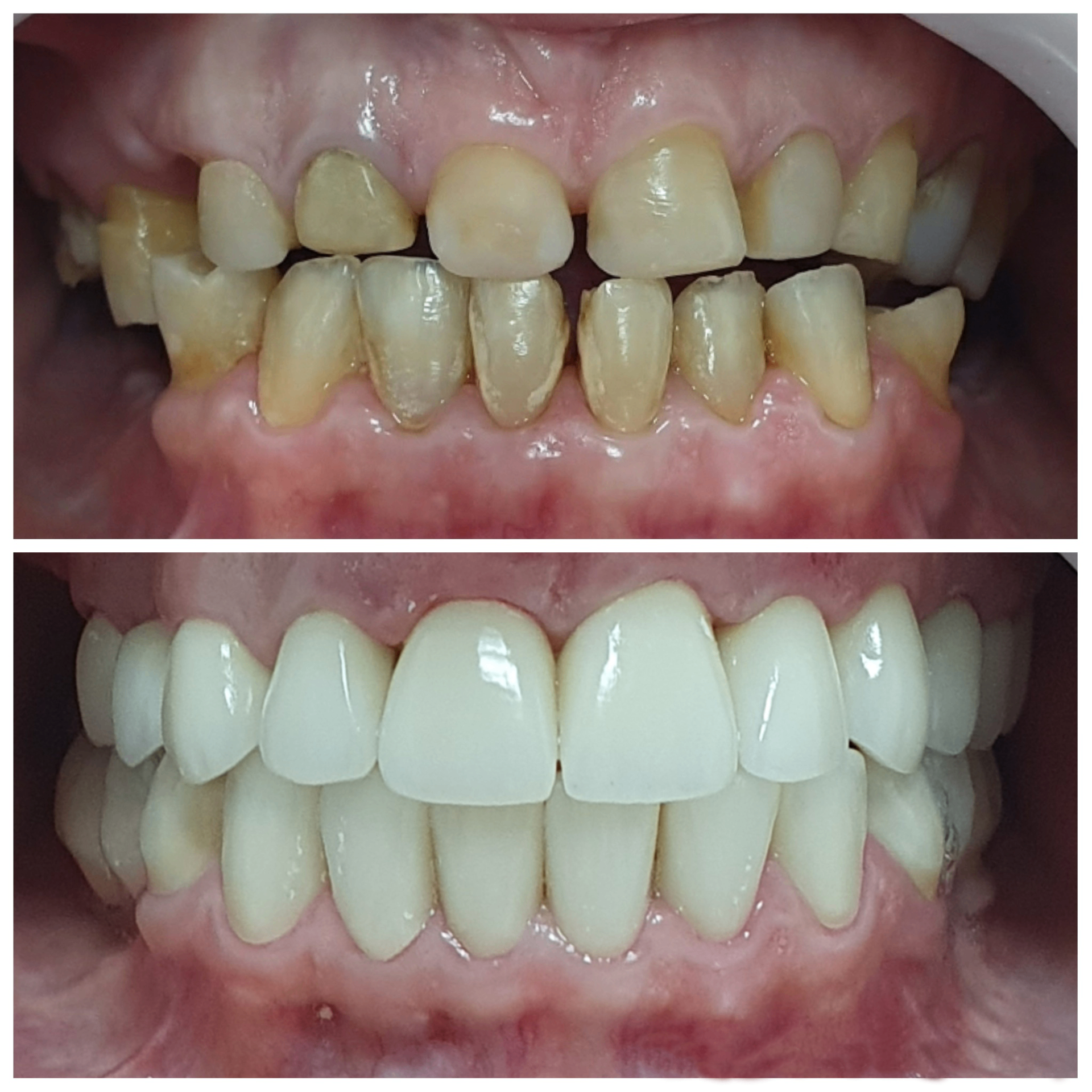 Lentes de contato — antes e depois