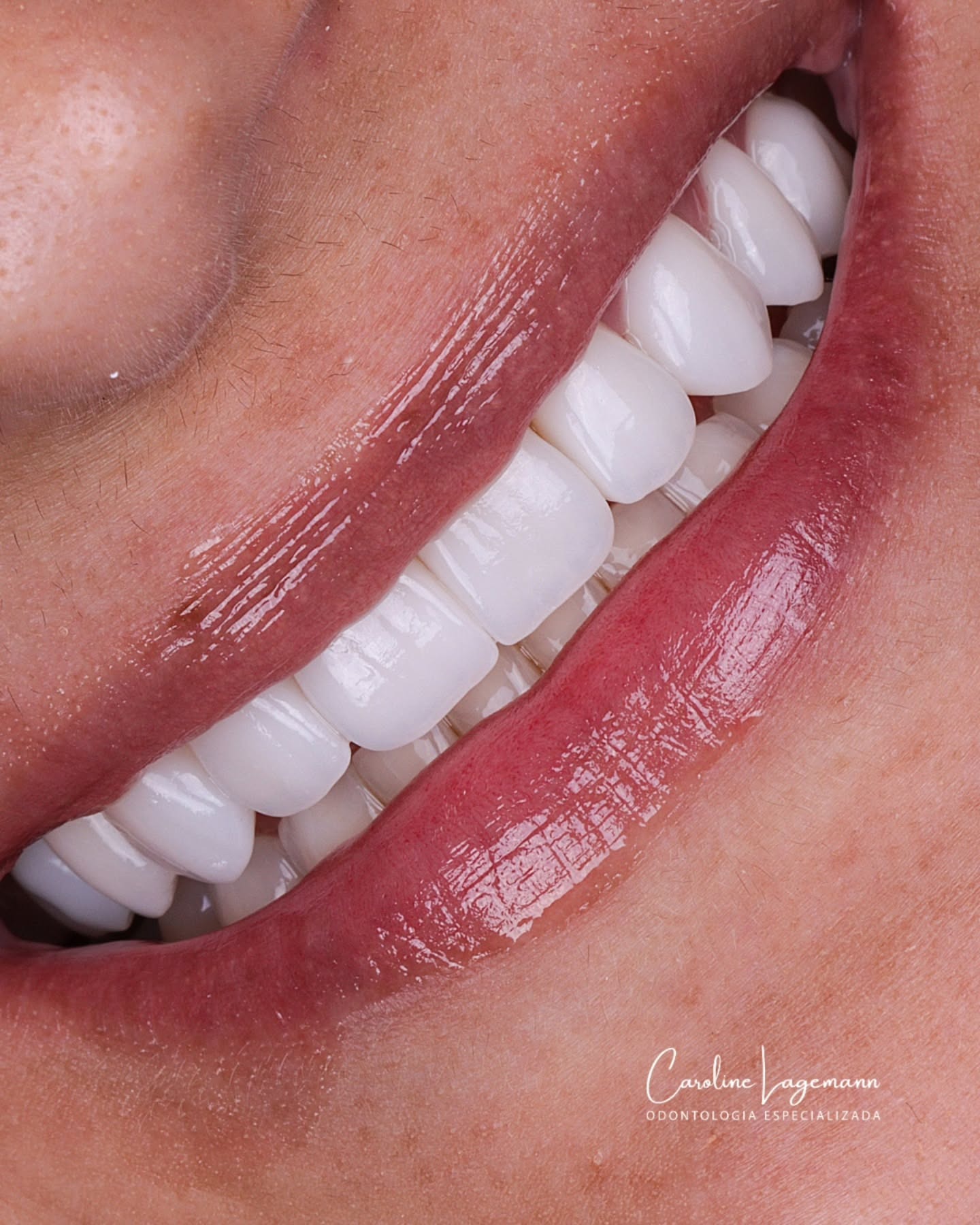 Lentes de contato dental — resultado