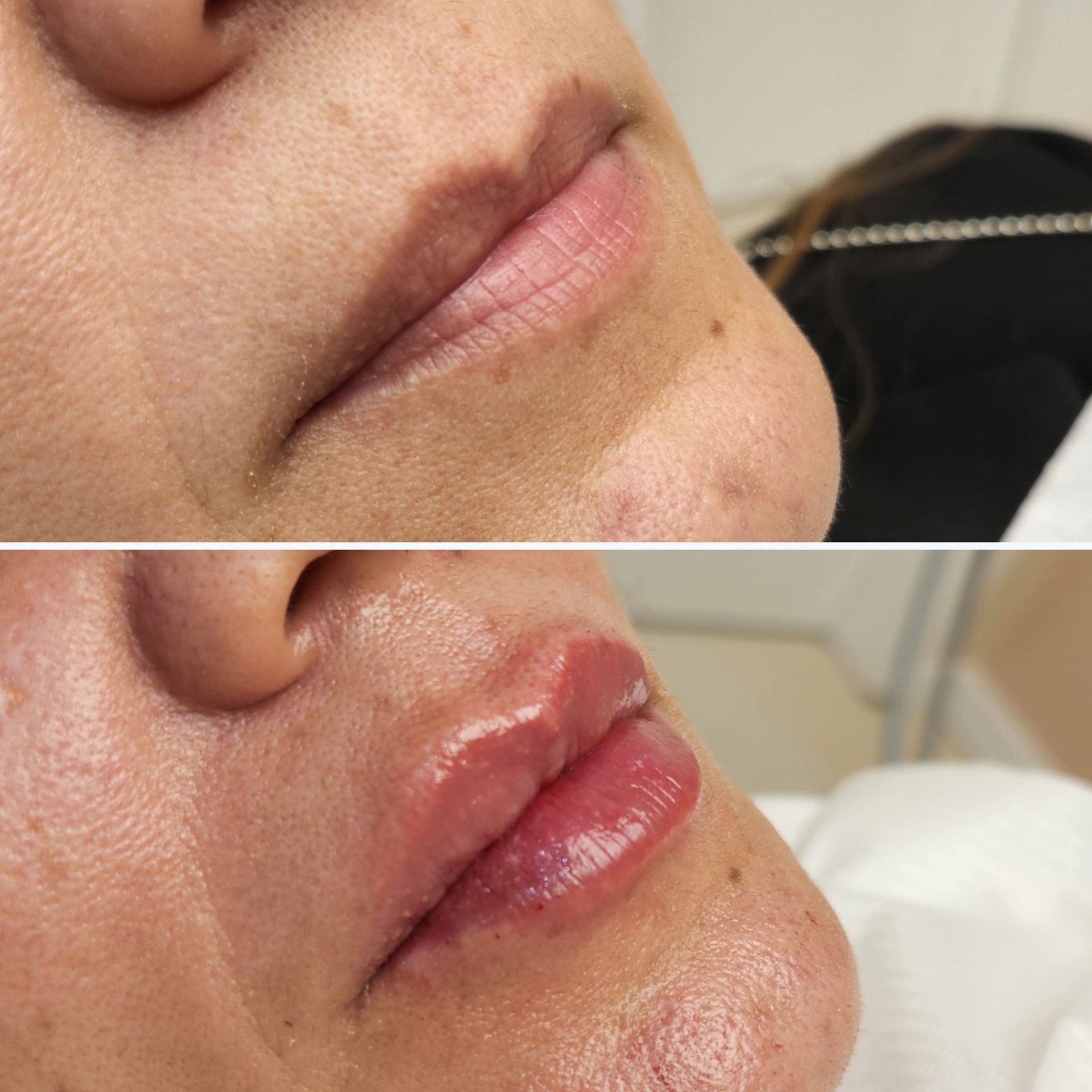Preenchimento labial — antes e depois