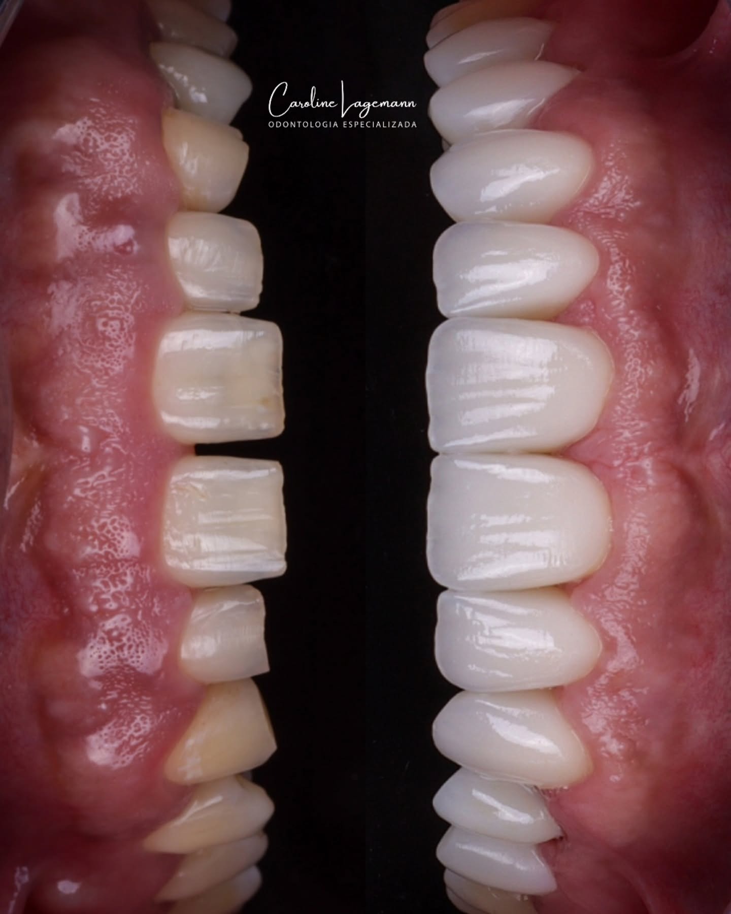 Facetas em porcelana — antes e depois