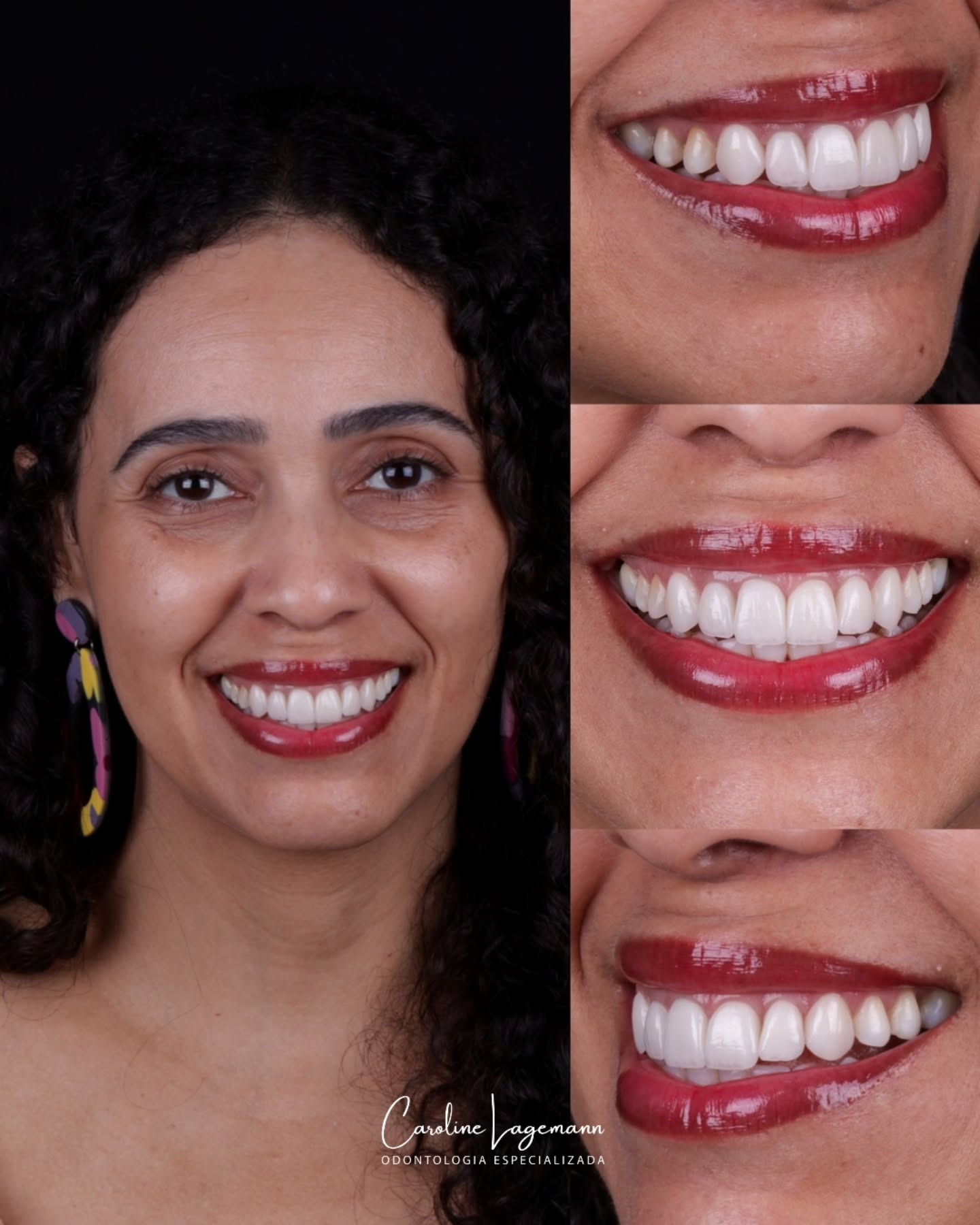 Reabilitação estética do sorriso